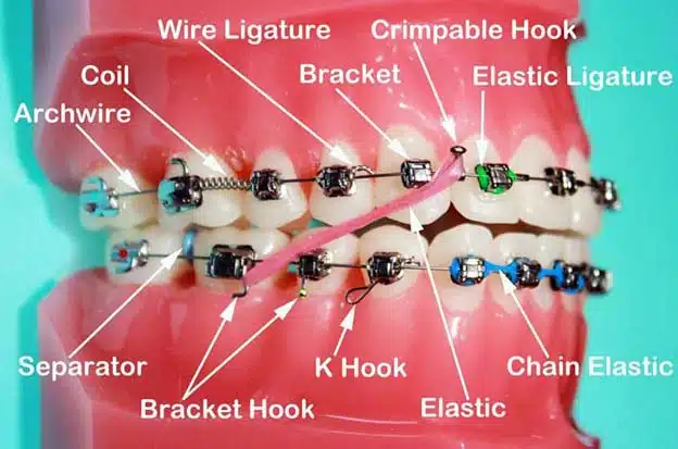 Taking Care Of Your Braces 1 Taking Care Of Braces