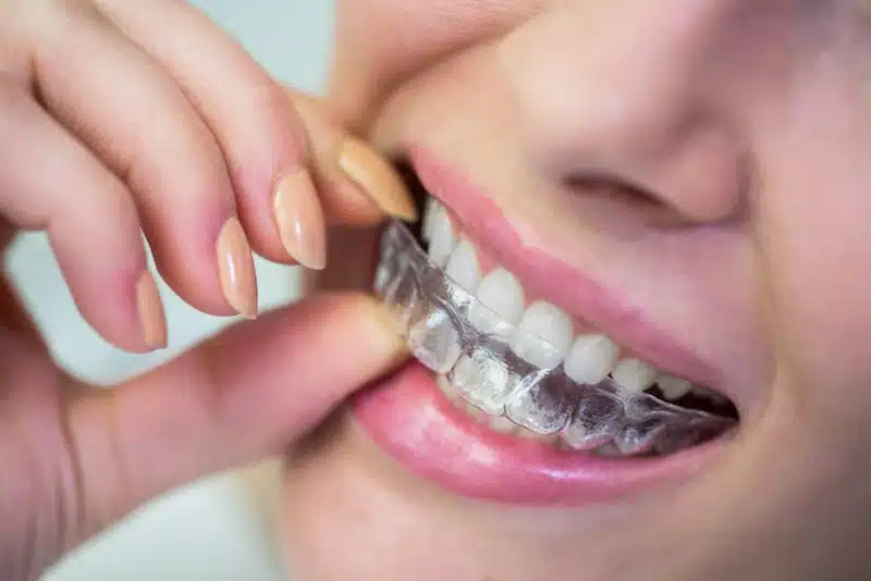 Invisalign In Ballantyne, Nc | Get A Confident Smile 1 Close-Up Of Clear Aligner Used For Invisalign In Ballantyne Nc Treatment